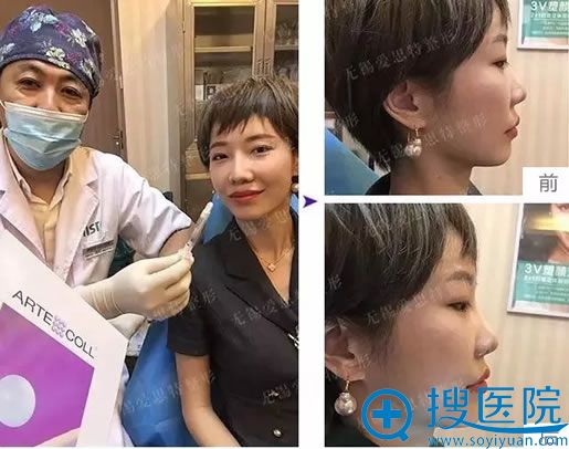 邵宏医生注射玻尿酸丰下巴案例 邵宏医生注射玻尿酸丰下巴案例