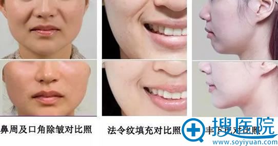 注射玻尿酸的案例效果图 注射玻尿酸的案例效果图