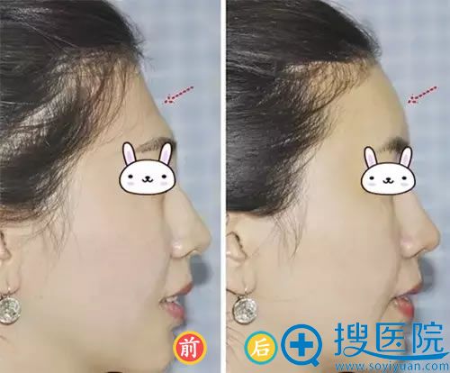 玻尿酸填充额头的效果 玻尿酸填充额头的效果