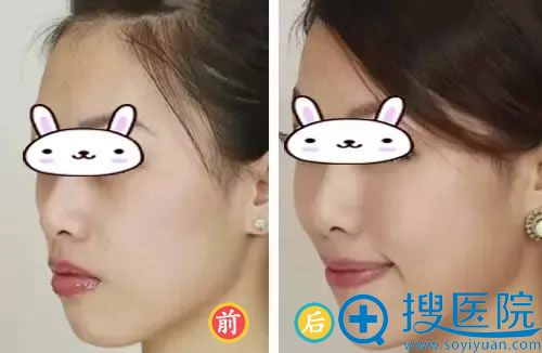 玻尿酸填充脸颊的效果 玻尿酸填充脸颊的效果