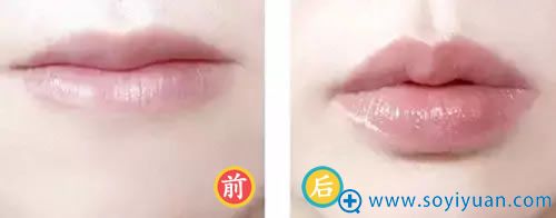 玻尿酸填充嘟嘟嘴的效果 玻尿酸填充嘟嘟嘴的效果