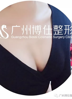 天生平胸的女主播在广州博仕做月亮女神假体隆胸后月收入10万