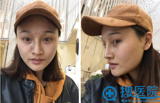 四川华美紫馨方晓娟玻尿酸丰苹果肌下巴+塑美效果分享