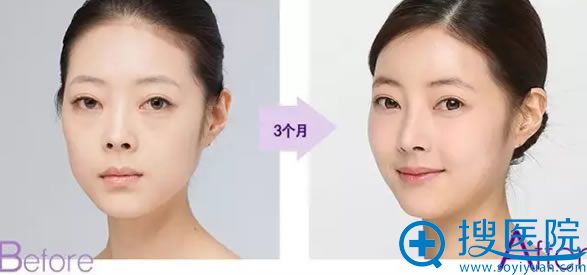 贵阳美贝尔自体肋软骨隆鼻案例 贵阳美贝尔自体肋软骨隆鼻案例