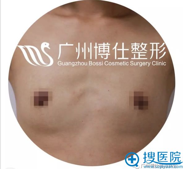 假体隆胸术前的照片 假体隆胸术前的照片