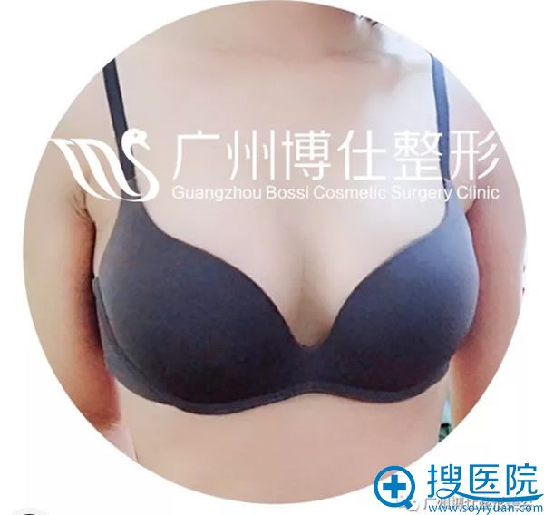 广州博仕整形月亮女神隆胸案例效果图 广州博仕整形月亮女神隆胸案例效果图