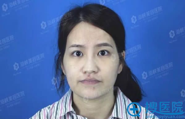 在济南海峡美容医院做整形前的样子 在济南海峡美容医院做整形前的样子