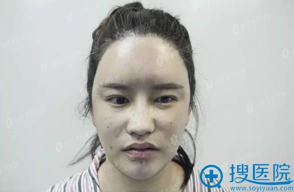 自体脂肪填充全脸术后即刻的样子 自体脂肪填充全脸术后即刻的样子