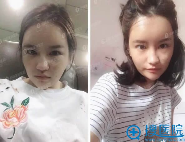 全面部自体脂肪填充术后第2天的照片 全面部自体脂肪填充术后第2天的照片
