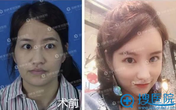 逄宝峰院长自体脂肪填充前后对比图 逄宝峰院长自体脂肪填充前后对比图