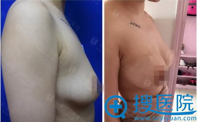 假体丰胸术前术后对比照片 假体丰胸术前术后对比照片