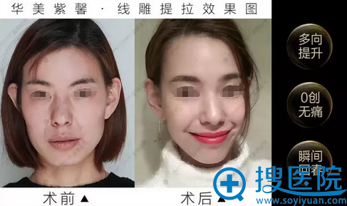 四川<!--<i data=20240710 data-id=16060></i>-->紫馨面部线雕提升案例效果图 四川<!--<i data=20240710 data-id=16060></i>-->紫馨面部线雕提升案例效果图