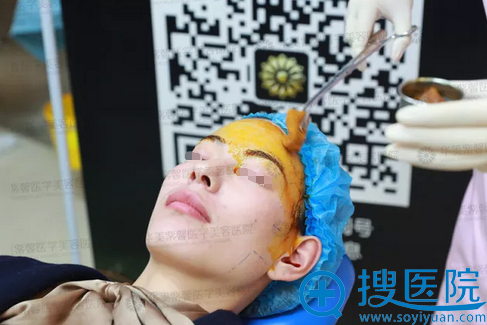 <!--<i data=20240710 data-id=13402></i>-->线雕术前面部消毒 <!--<i data=20240710 data-id=13402></i>-->线雕术前面部消毒