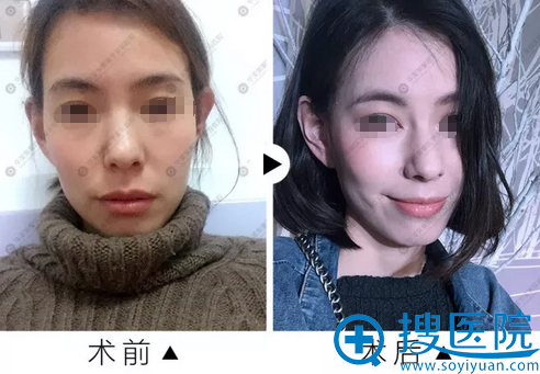 线雕提升术后对比照片 线雕提升术后对比照片