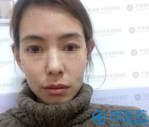 面部线雕提升术前照片 面部线雕提升术前照片