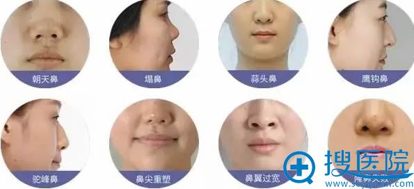 鼻综合整形适合的人群 鼻综合整形适合的人群