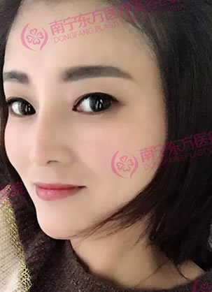 注射隆鼻失败后终于在南宁东方通过鼻综合手术修复成功