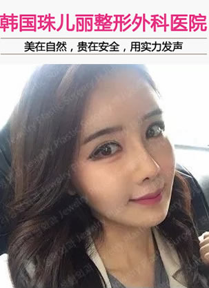 公开在韩国珠儿丽整形医院花9.8万做颧骨内推前后对比图