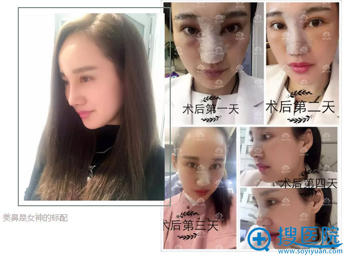 武汉禾丽刘娟隆鼻案例 武汉禾丽刘娟隆鼻案例