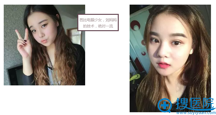 武汉禾丽刘娟双眼皮案例 武汉禾丽刘娟双眼皮案例