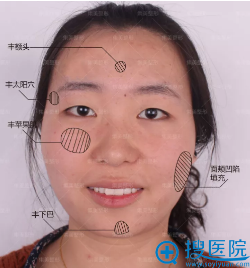 郑州哪家做脂肪填充好?集美整形医院全脸脂肪填充案例告诉你