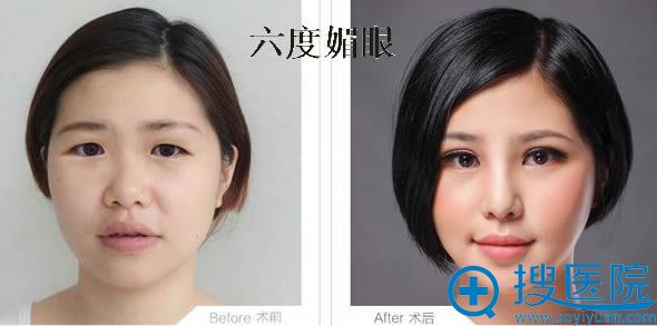 柳州华美兰磊双眼皮案例 柳州华美兰磊双眼皮案例