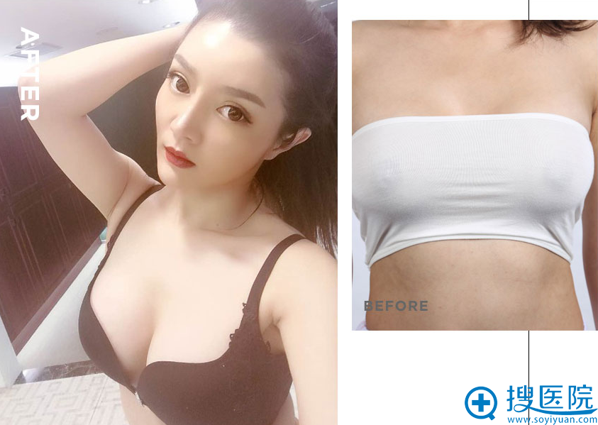 上海时光许黎平自体脂肪隆胸案例 上海时光许黎平自体脂肪隆胸案例