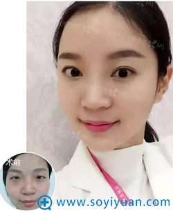 郑州集美整形医院眼综合案例 郑州集美整形医院眼综合案例