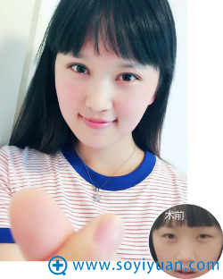 郑州集美整形医院切开双眼皮案例 郑州集美整形医院切开双眼皮案例