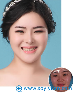 郑州集美整形医院假体隆鼻案例 郑州集美整形医院假体隆鼻案例