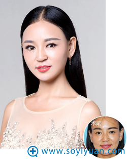 郑州集美自体脂肪丰苹果肌案例 郑州集美自体脂肪丰苹果肌案例
