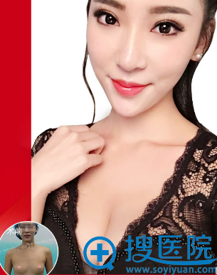 郑州集美假体丰胸案例 郑州集美假体丰胸案例