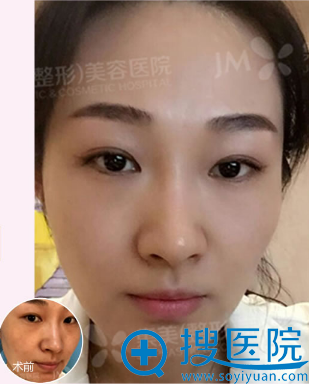 郑州集美皮秒祛斑案例 郑州集美皮秒祛斑案例