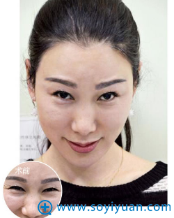郑州集美除皱案例 郑州集美除皱案例