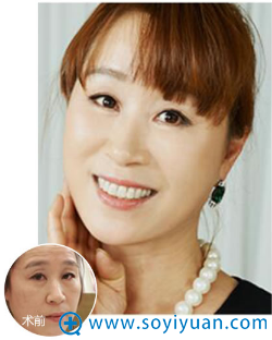 郑州集美除皱案例 郑州集美除皱案例