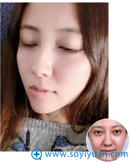 郑州集美玻尿酸填充案例 郑州集美玻尿酸填充案例