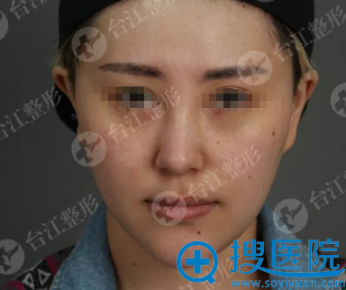 找福州台江虞守辉主任注射的妹子分享术后15天治疗效果图