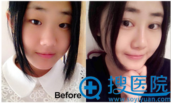 上海华美双眼皮案例 上海华美双眼皮案例