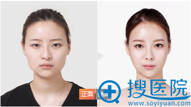 上海华美下颌角整形案例 上海华美下颌角整形案例