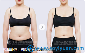 上海华美腰腹吸脂案例 上海华美腰腹吸脂案例