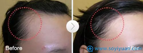 维多利亚植发案例图 维多利亚植发案例图