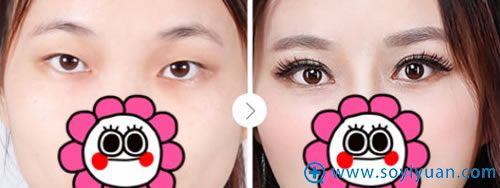 杭州维多利亚双眼皮案例图 杭州维多利亚双眼皮案例图