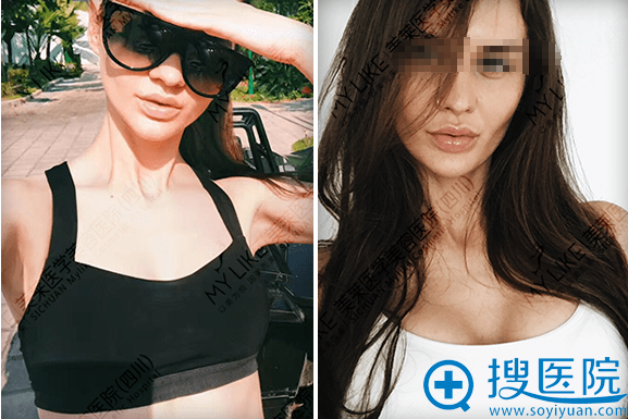 四川成都美莱假体隆胸案例 四川成都美莱假体隆胸案例
