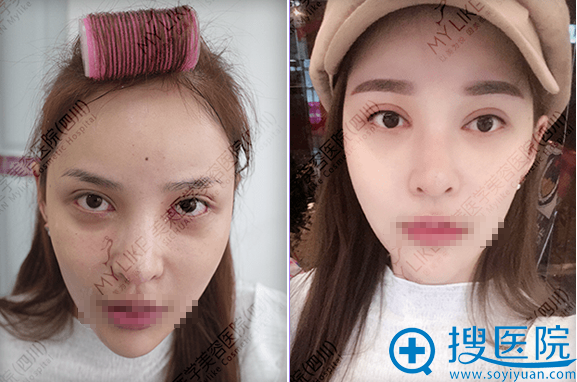 四川成都美莱韩式半纹眉+美瞳线 四川成都美莱韩式半纹眉+美瞳线