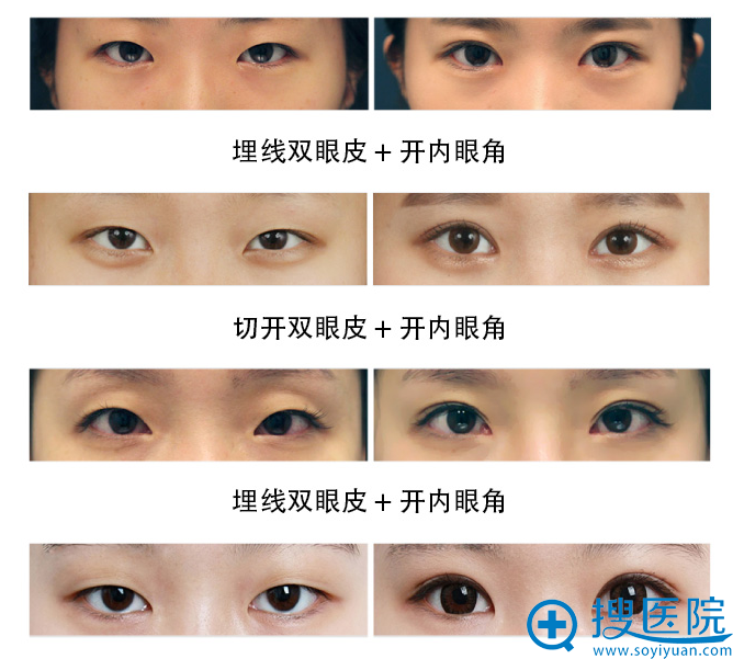上海铂曼医疗美容医院双眼皮案例 上海铂曼医疗美容医院双眼皮案例