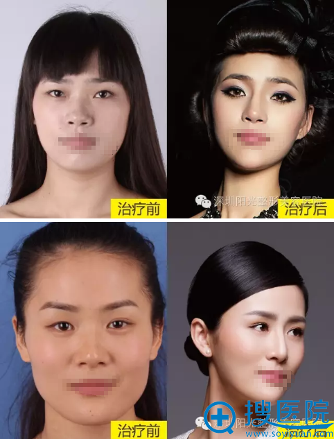 <!--<i data=20240710 data-id=12045></i>-->罗志敏鼻综合案例 <!--<i data=20240710 data-id=12045></i>-->罗志敏鼻综合案例
