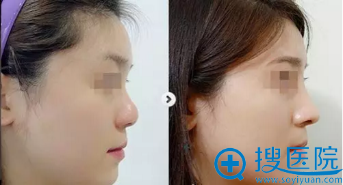 汪玉云鼻综合整形案例 汪玉云鼻综合整形案例