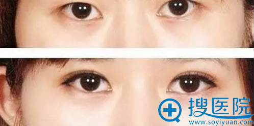 汪玉云双眼皮案例 汪玉云双眼皮案例