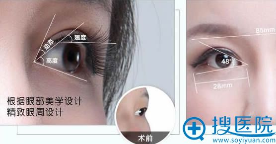 西安高一生双眼皮效果图 西安高一生双眼皮效果图