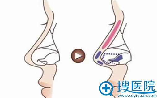 膨体隆鼻效果图 膨体隆鼻效果图